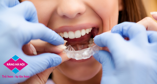 chinh nha invisalign